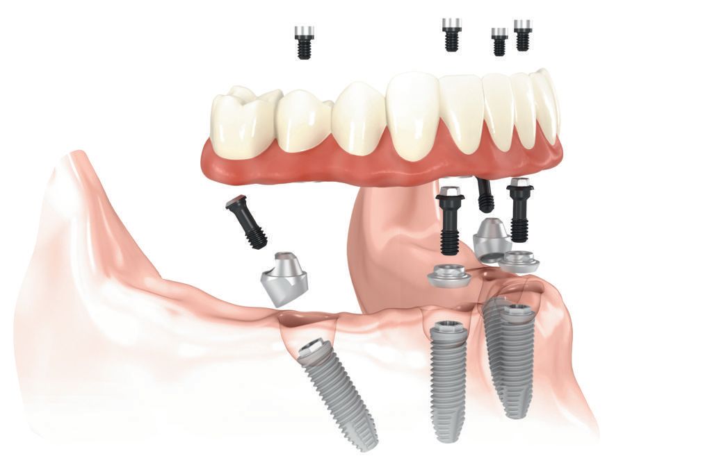 diagram of how dental implants work