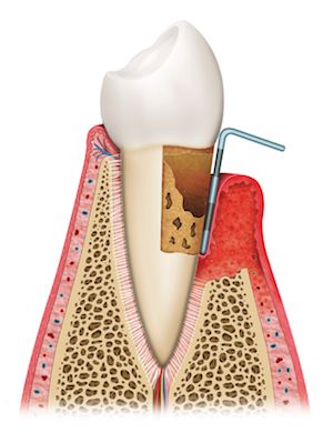 example of how periodontal treatment can help gum inflammation