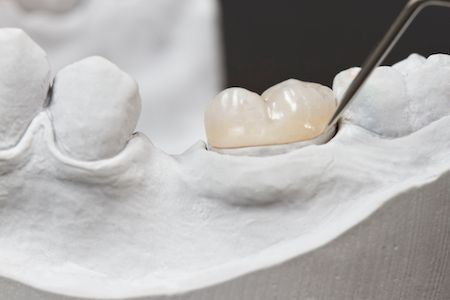 example of restorative dentistry