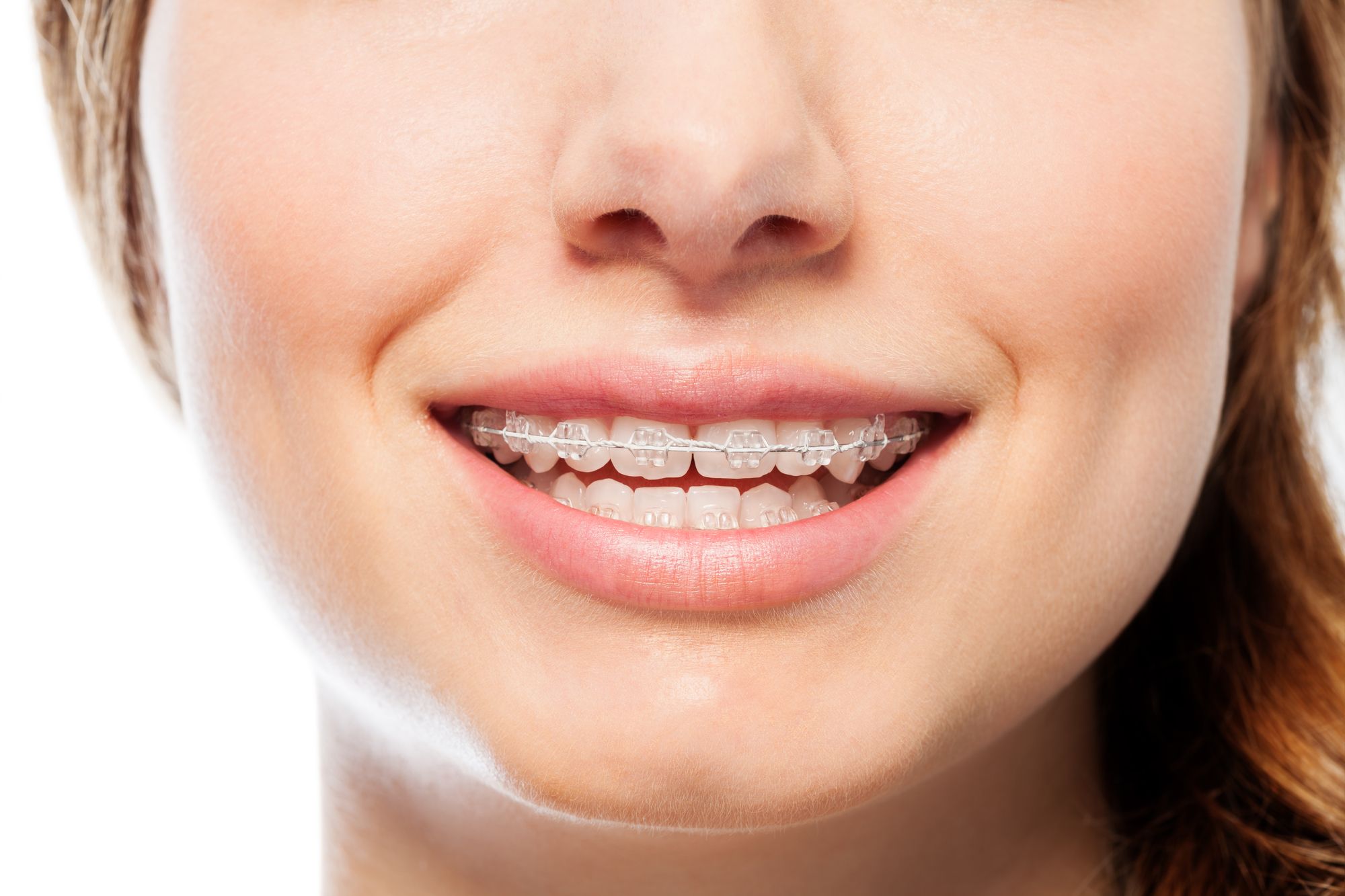 woman with six month smiles braces