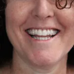 woman smiling with her Invisalign aligners on