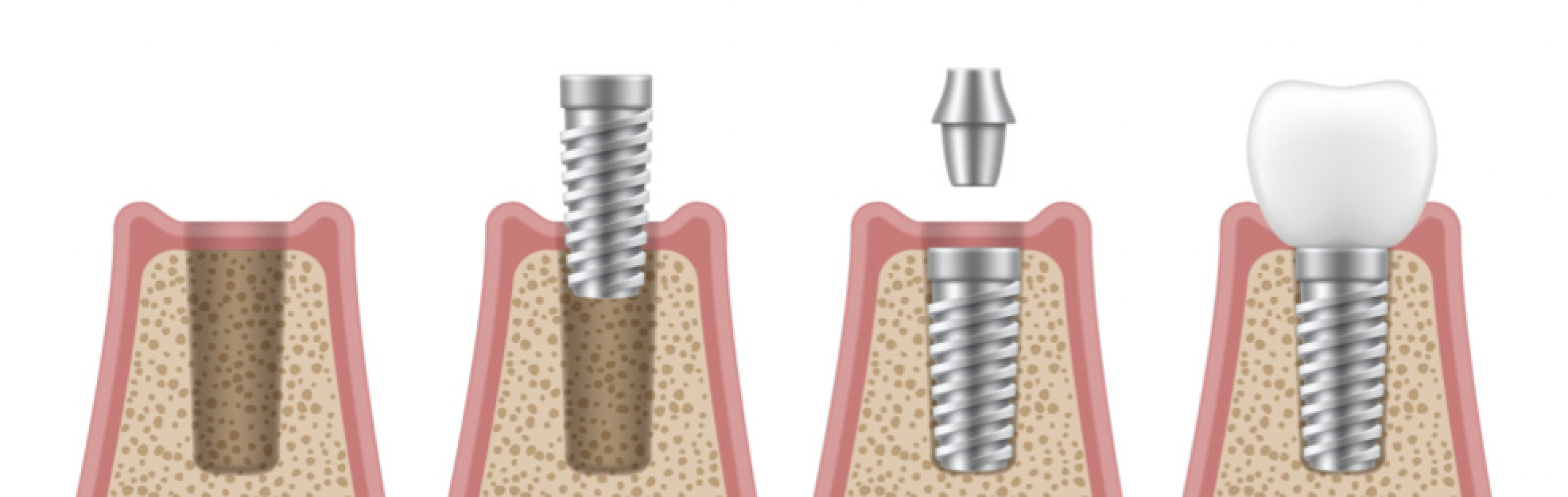 dental implants Beverly hills ca